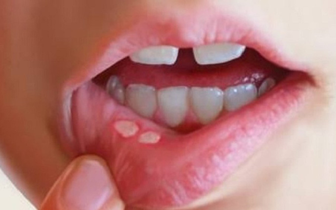 Triệu chứng của bệnh lậu ở miệng là gì?