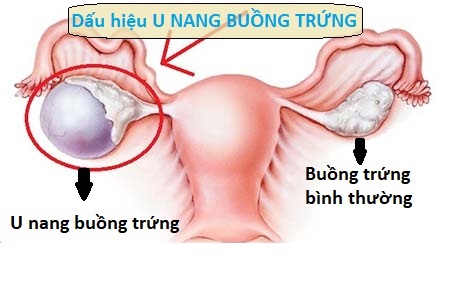 Hinh Anh U Nang Buong Trung