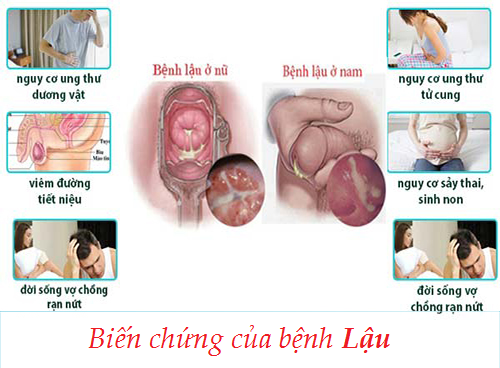 Bien Chung Cua Benh Lau