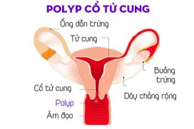 Polyp Co Tu Cung