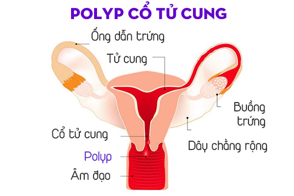 Polyp cổ tử cung là bệnh gì?