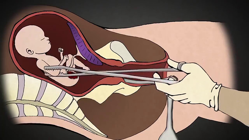 Hậu quả của nạo phá thai không an toàn gây ra cho phụ nữ